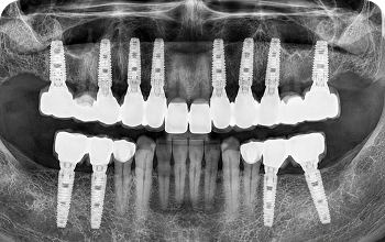 전체 임플란트