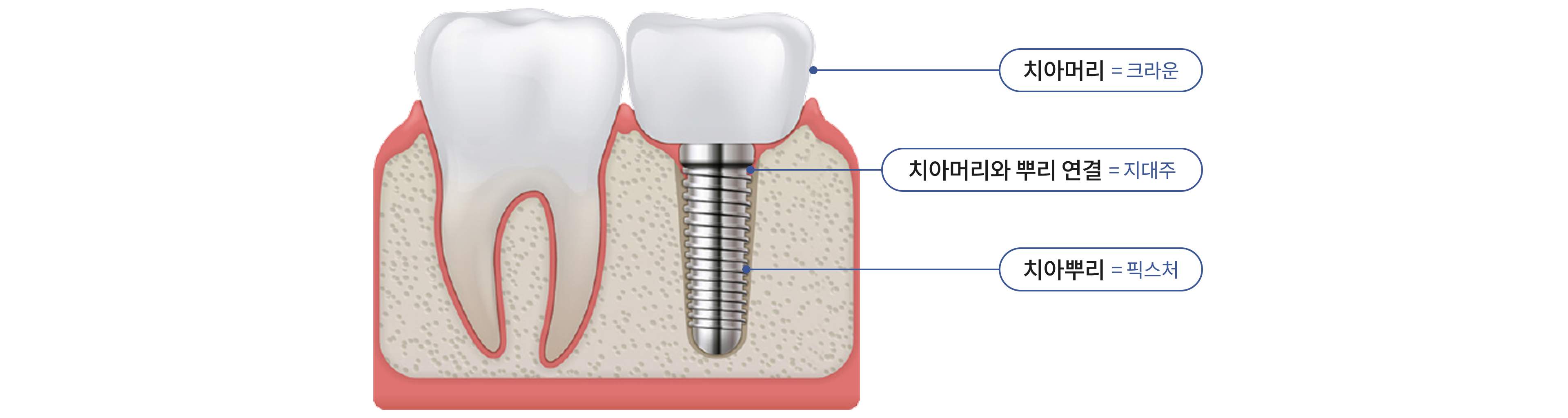 임플란트 구조